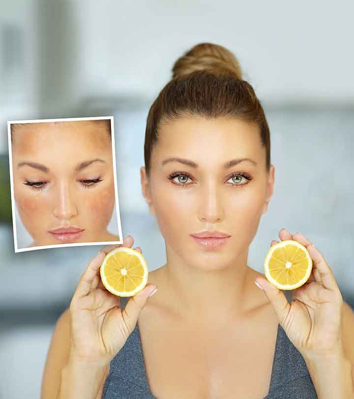 How to Remove Dark Spots on Your Face with Lemon Juice 